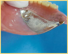 メタル義歯